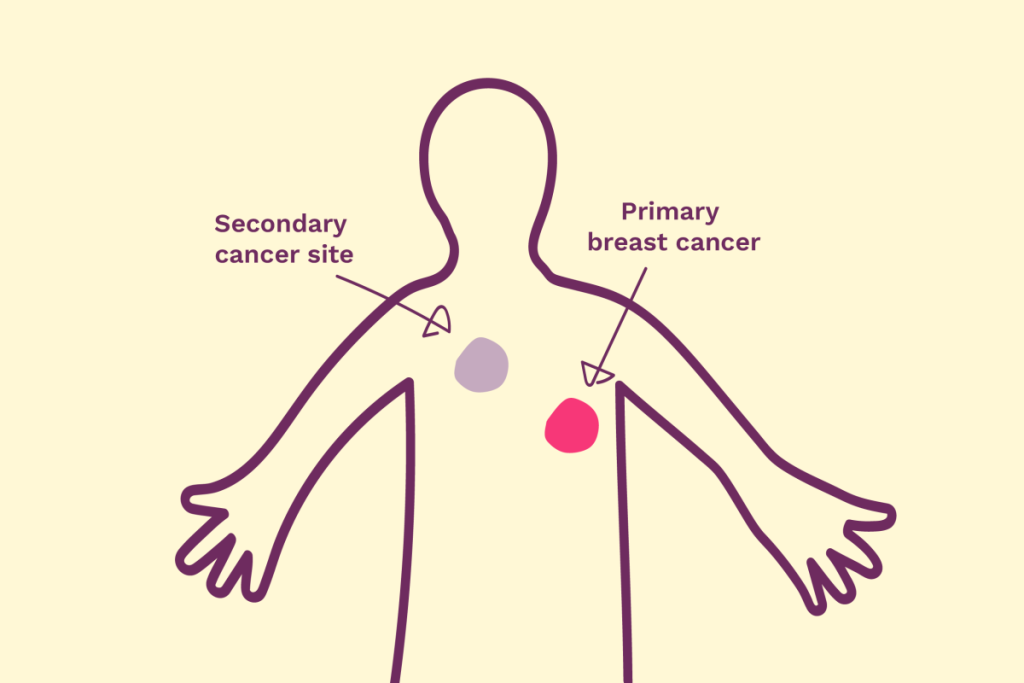 Secondary Breast Cancer Awareness: 13/10/22